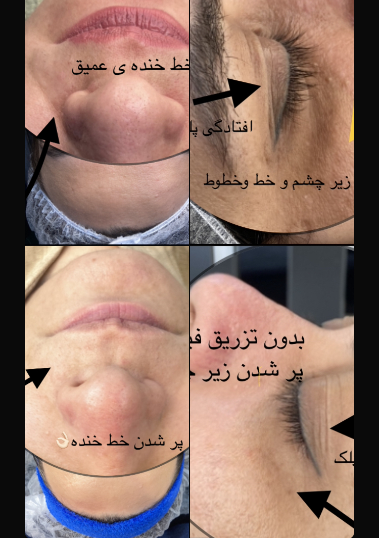 پکیج شش‌جلسه ای فیشال شبه بوتاکس